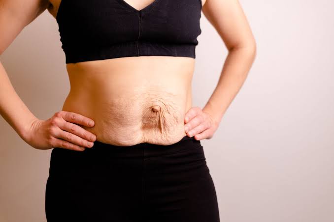 Is Surgery Really the Only Way to Repair Diastasis Recti Henley-on-Thames?