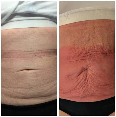 How Does RF Microneedling Improve Crepey, Thin and Uneven Skin Texture Henley-on-Thames?