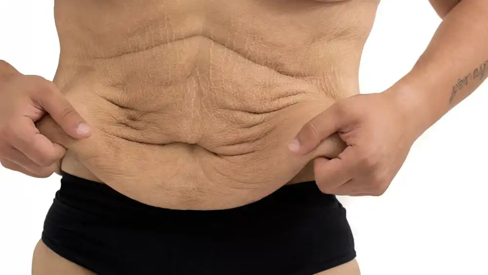 RF Microneedling for Loose Skin: How Can It Help Tighten and Reshape the Skin Henley-on-Thames?
